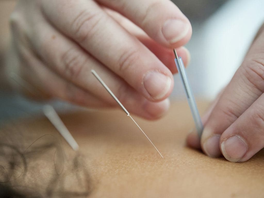 A calm acupuncture treatment with fine needles