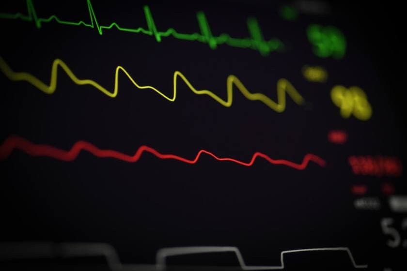 An ECG heart-rhythm trace on a monitor